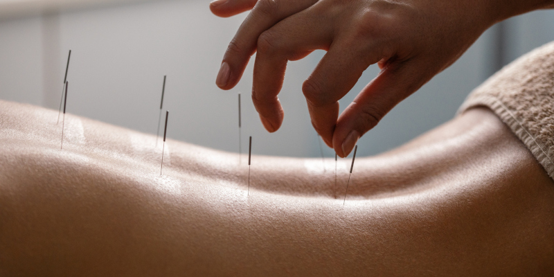 Acupuncture