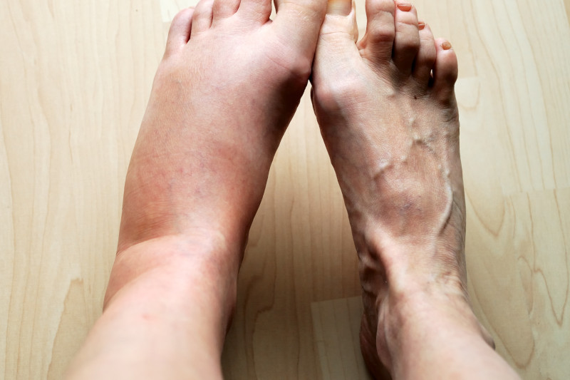 Lymphedema Physiotherapy in Newmarket, Ontario
